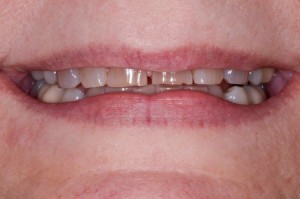 dental patient with occlusal wear