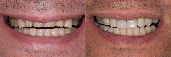 patient's teeth before and after dental treatments for occlusal wear