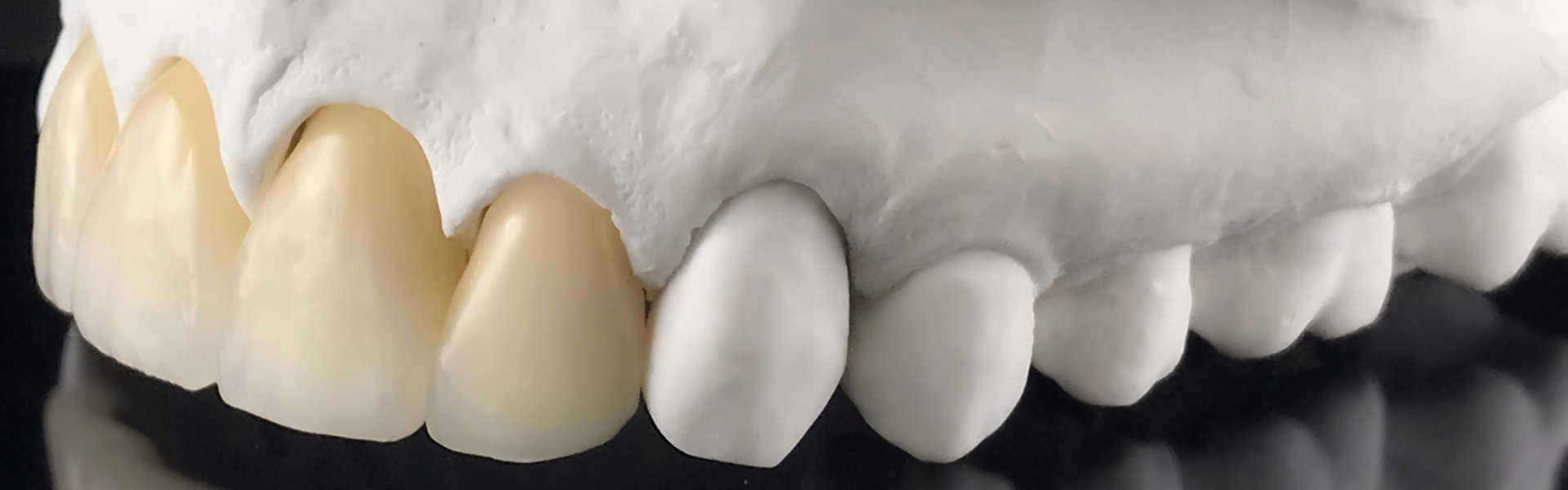 Dental prosthesis porcelain teeth in a mold.