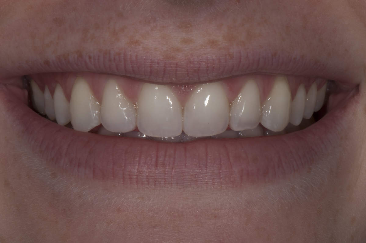 Straight Teeth with Dental Crowns
