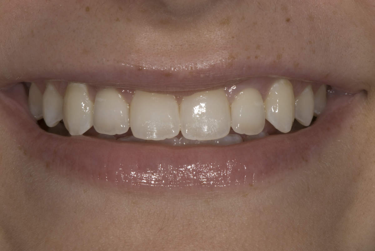 Teeth Replacement in Marietta GA