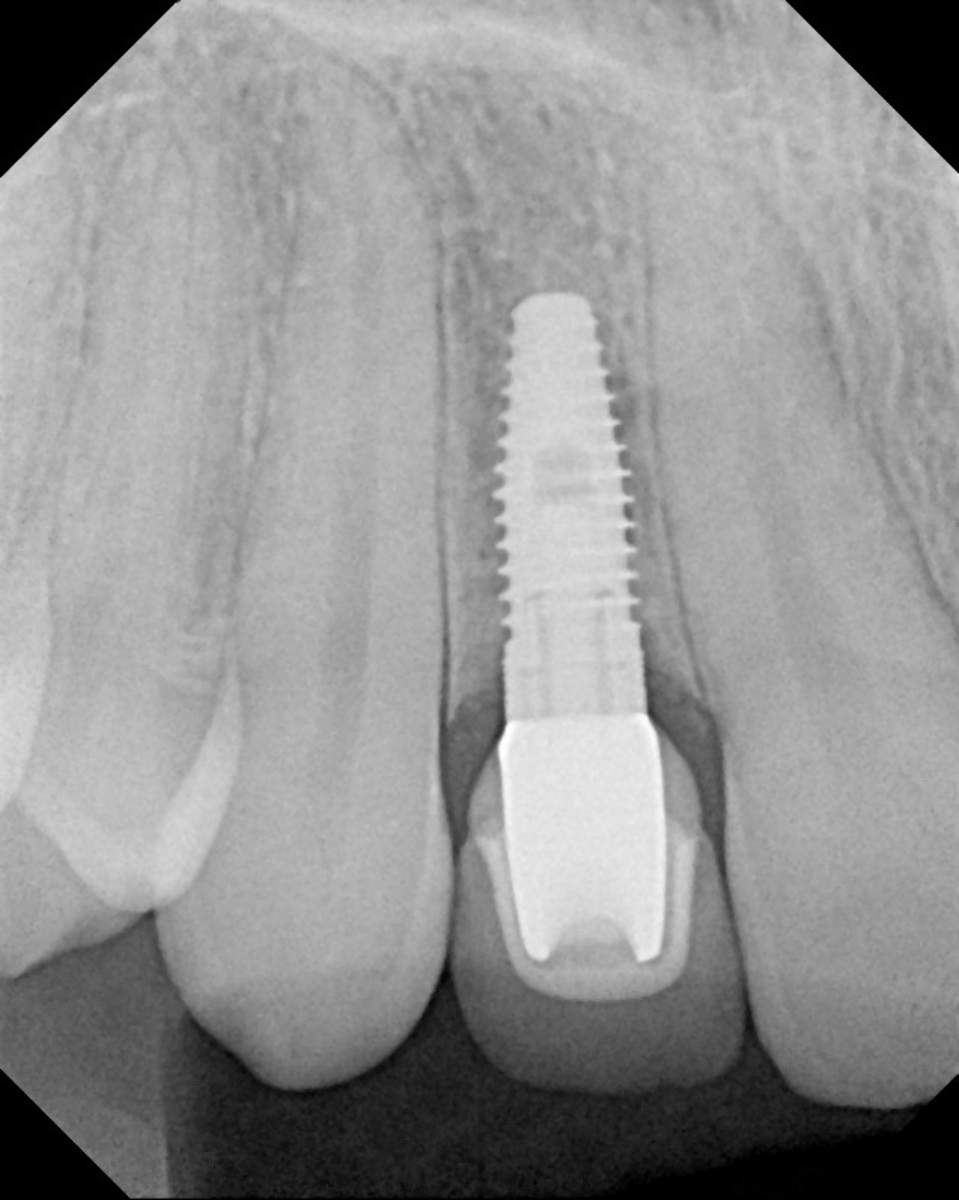 Dental Implant Xray (1)