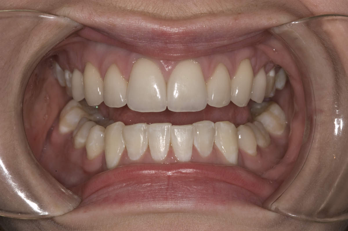 Teeth Whitening Marietta GA