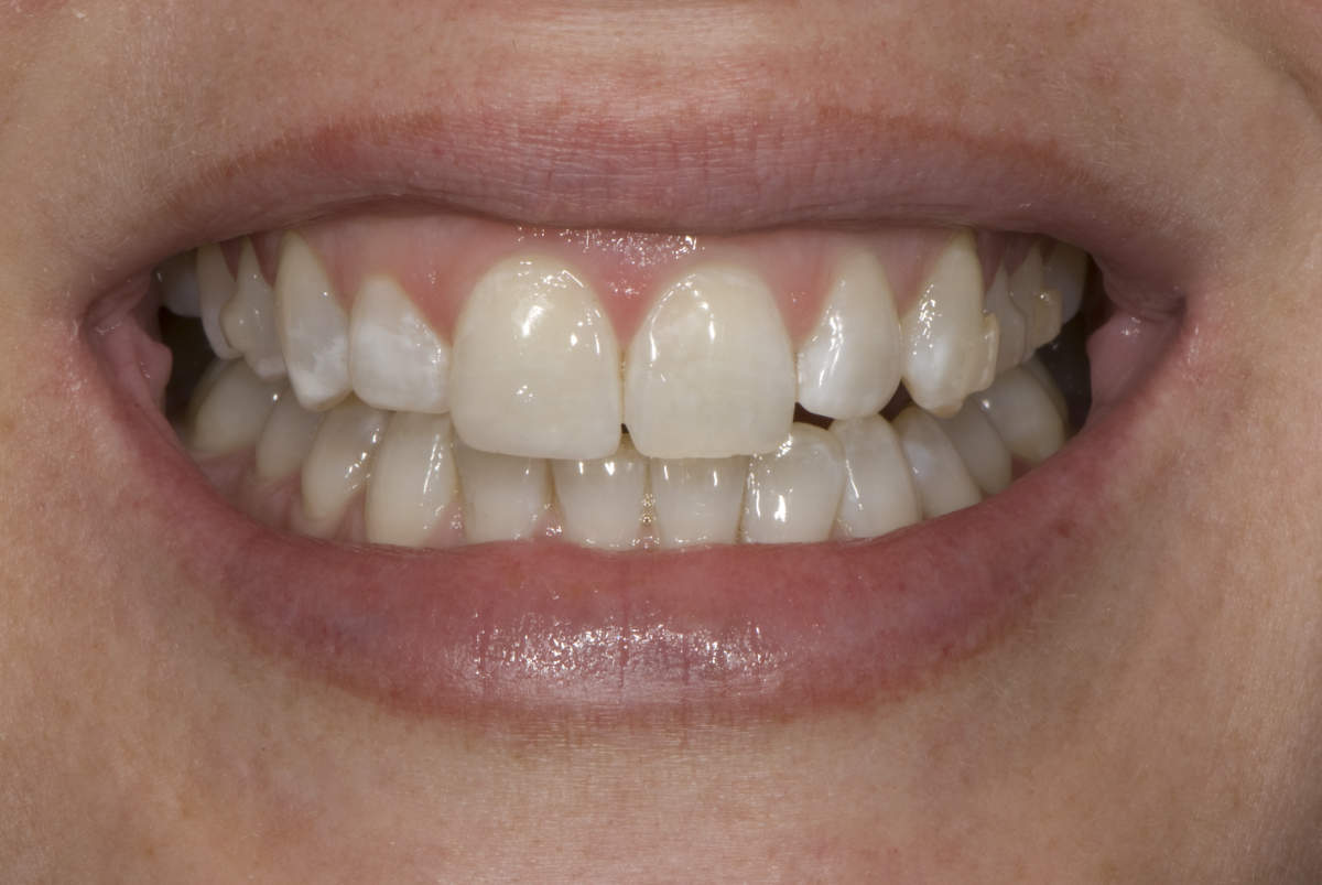 Chipped Tooth Repair Dental Veneer - After