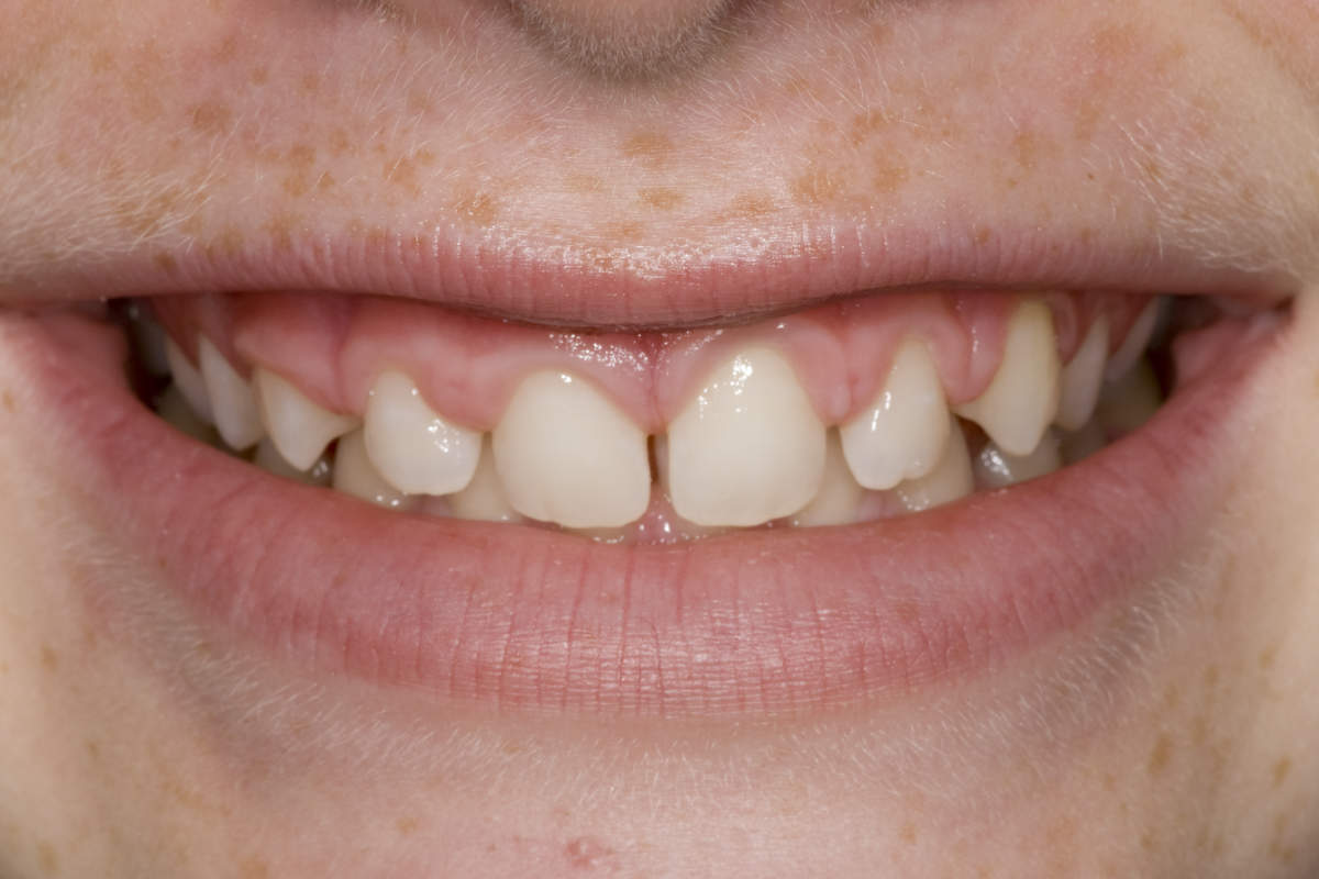 Teeth Gaps