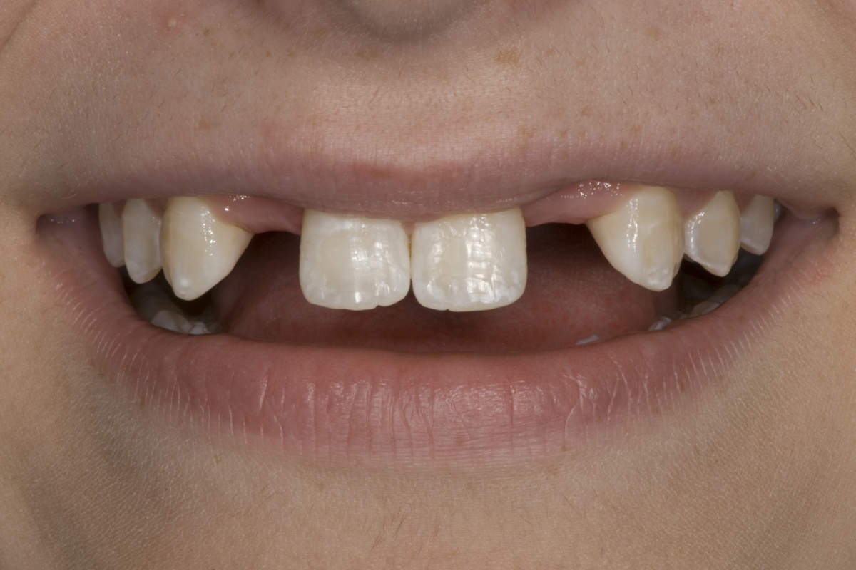 Teeth Replacement Marietta GA