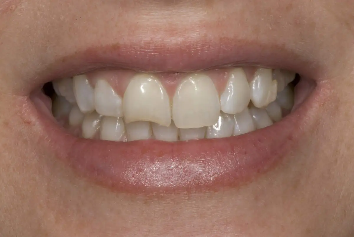Chipped Tooth Repair Dental Veneer - Before
