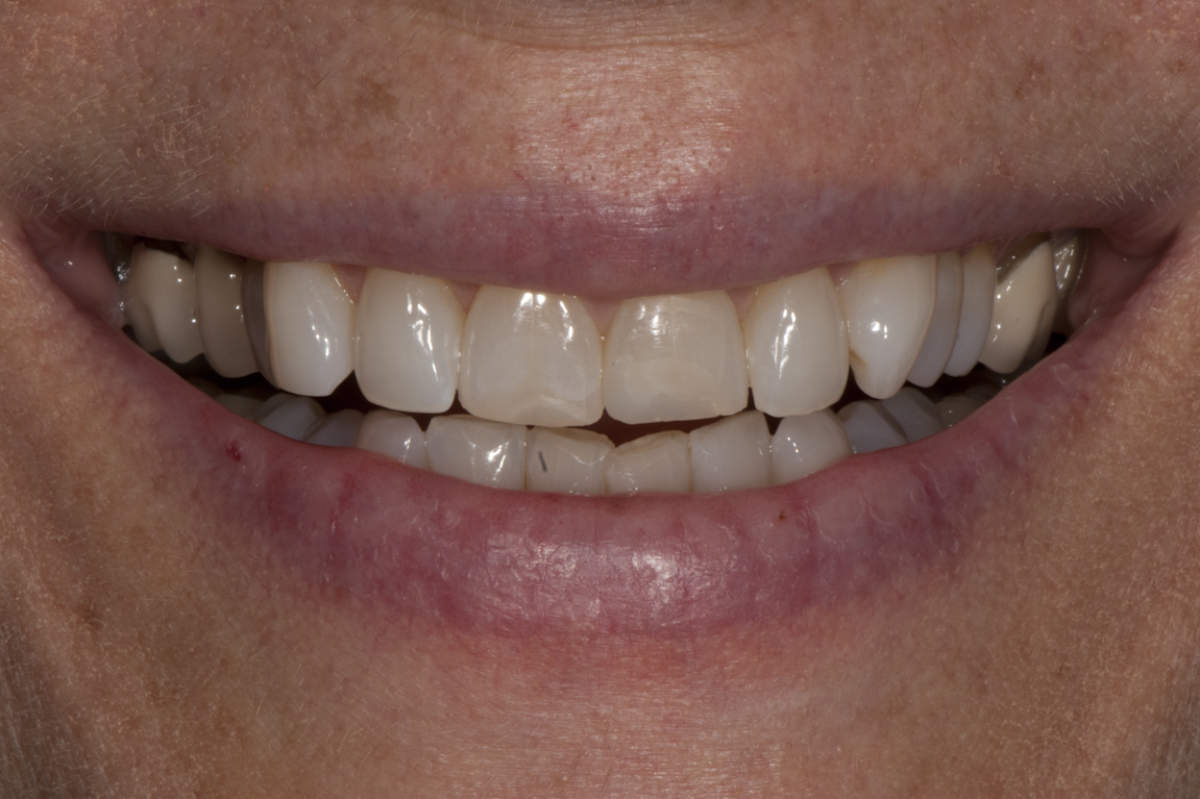 Crooked Teeth Marietta GA (2)