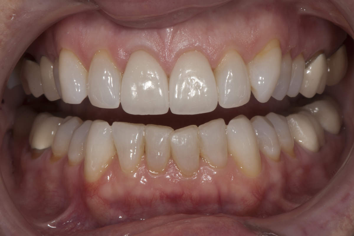 Crooked Teeth Marietta GA (1)