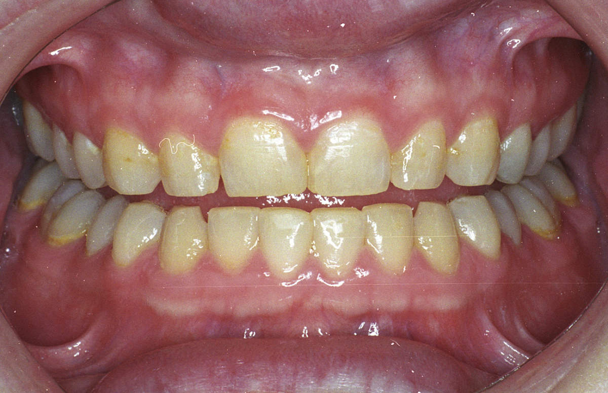 Stained Teeth Marietta GA